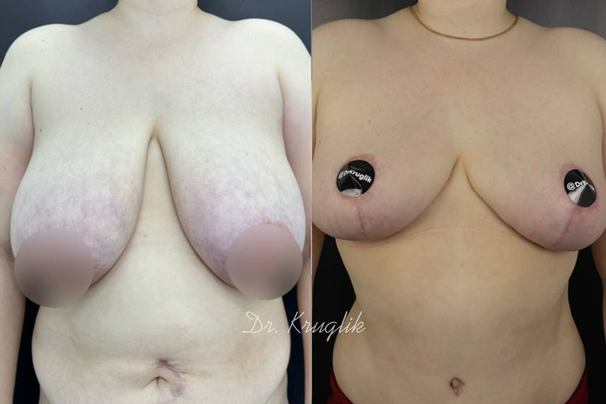Уменьшение груди (редукция) 01