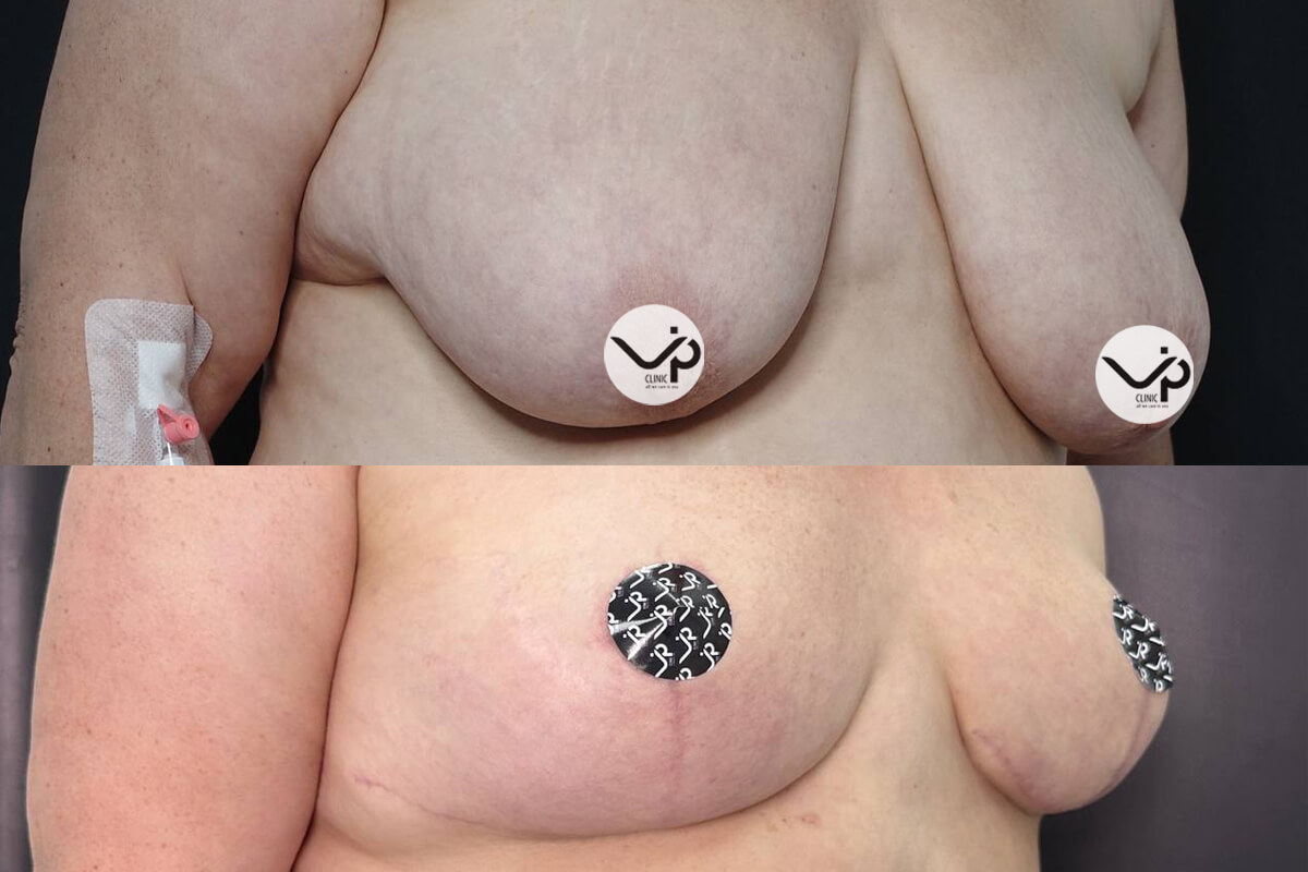 Уменьшение груди (редукция) 01