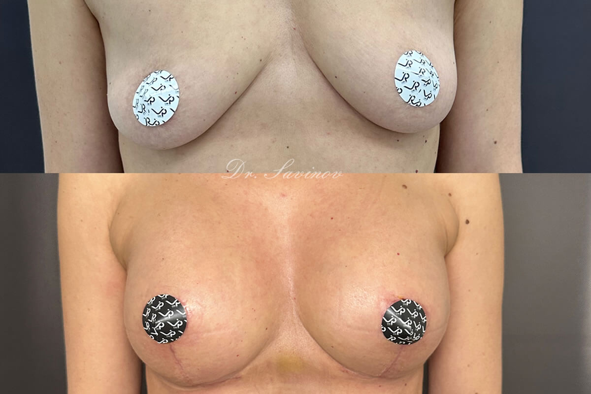 Подтяжка груди (мастопексия) 01