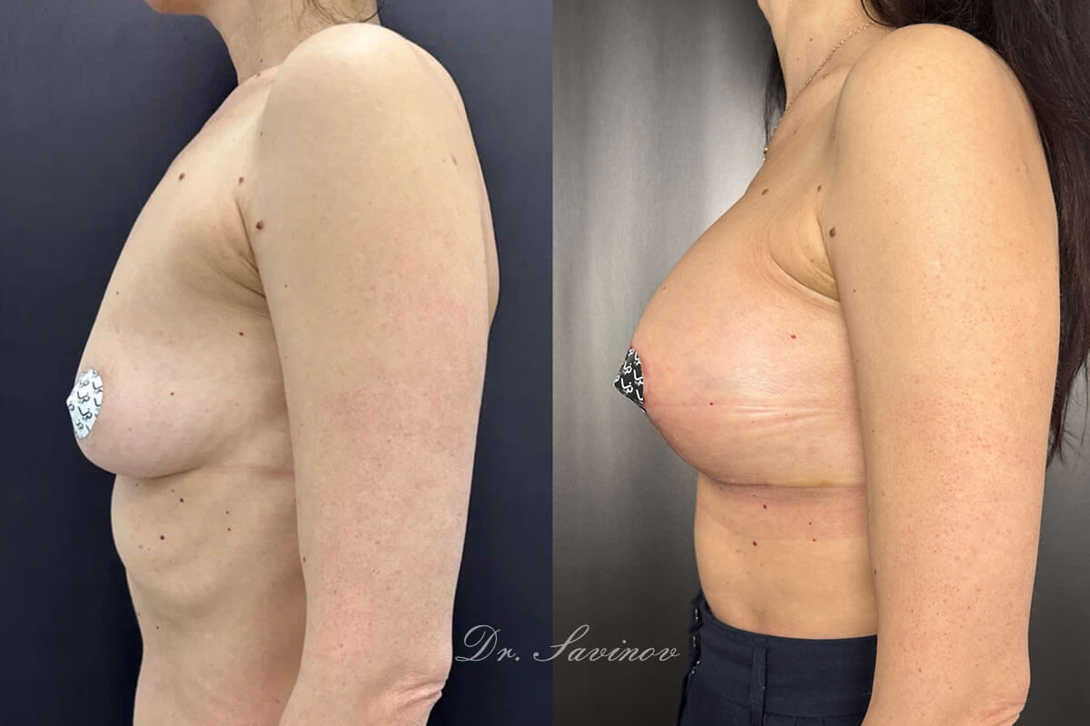 Подтяжка груди (мастопексия) 01