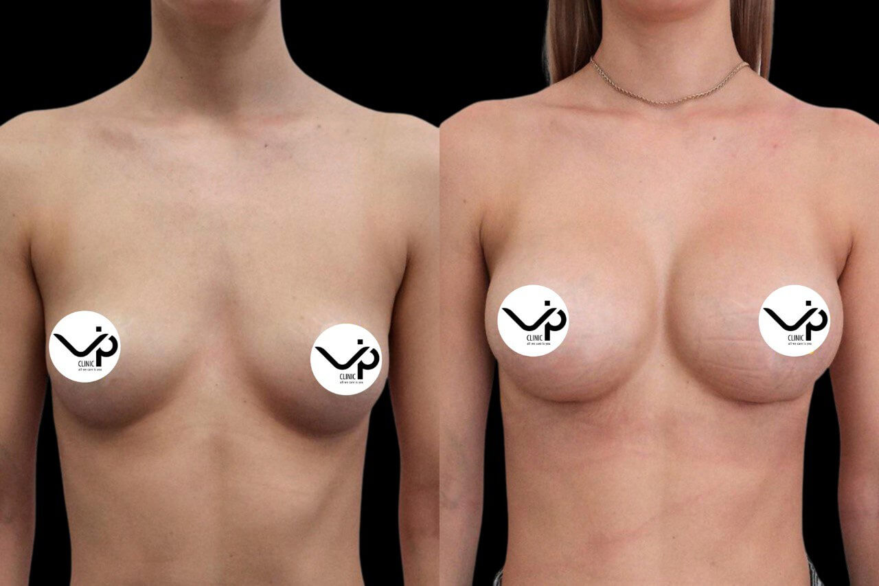 Подтяжка груди (мастопексия) 01