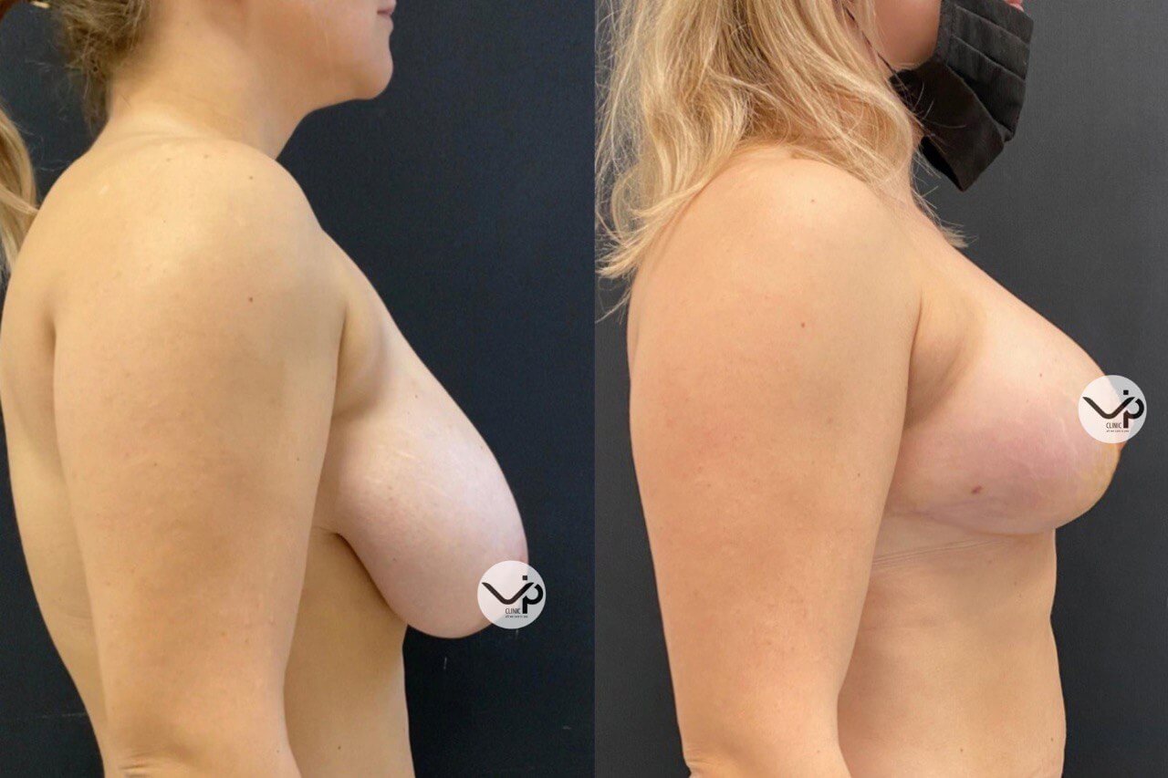 Подтяжка груди (мастопексия) 01