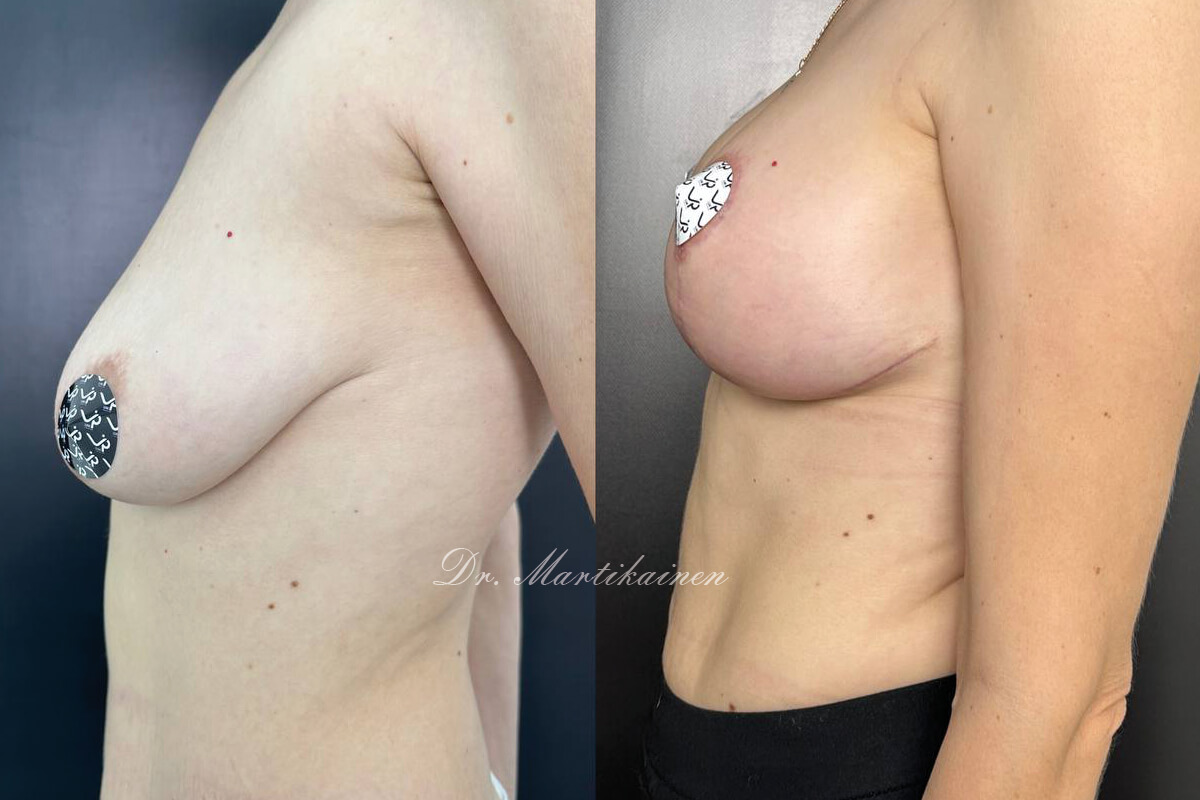 Подтяжка груди (мастопексия) 01