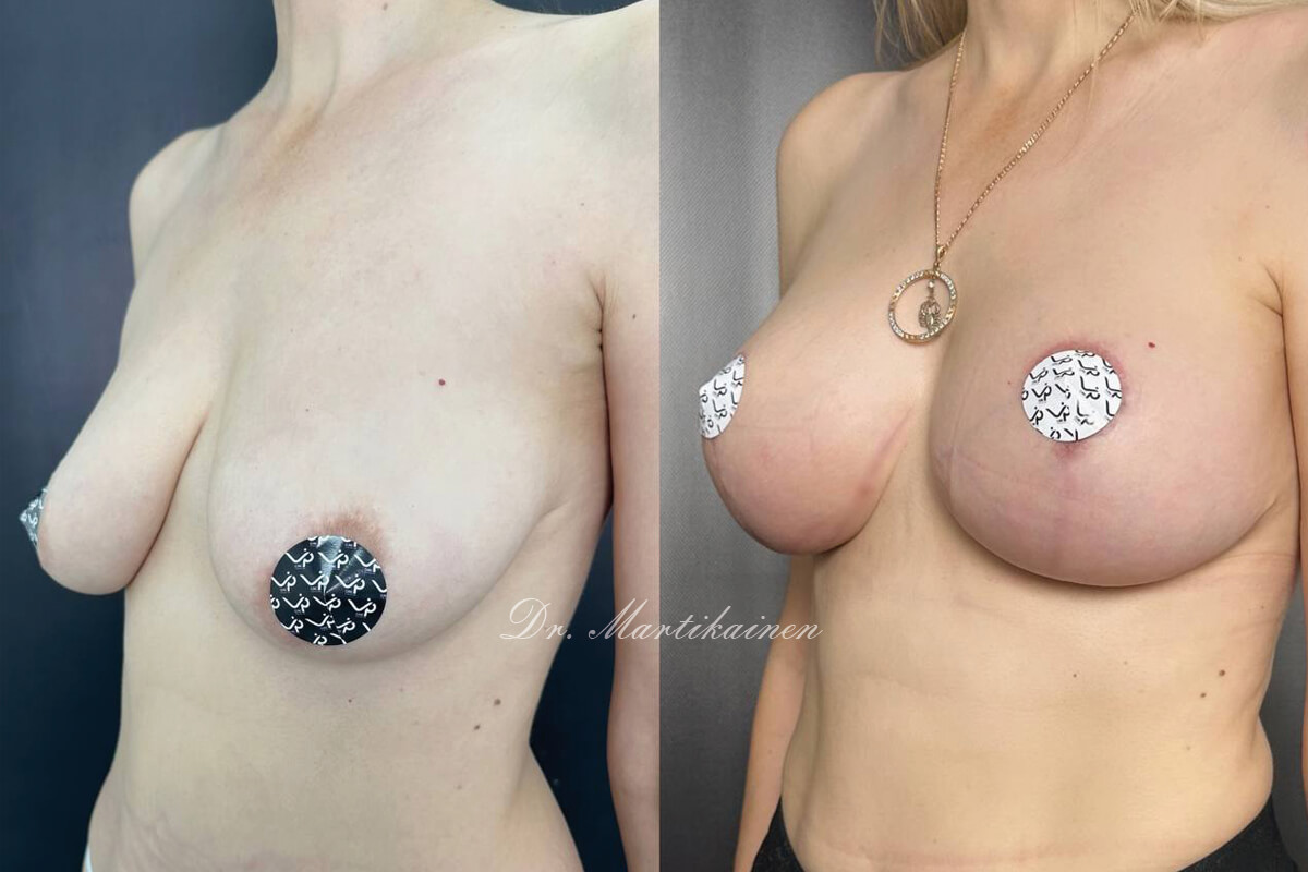 Подтяжка груди (мастопексия) 01