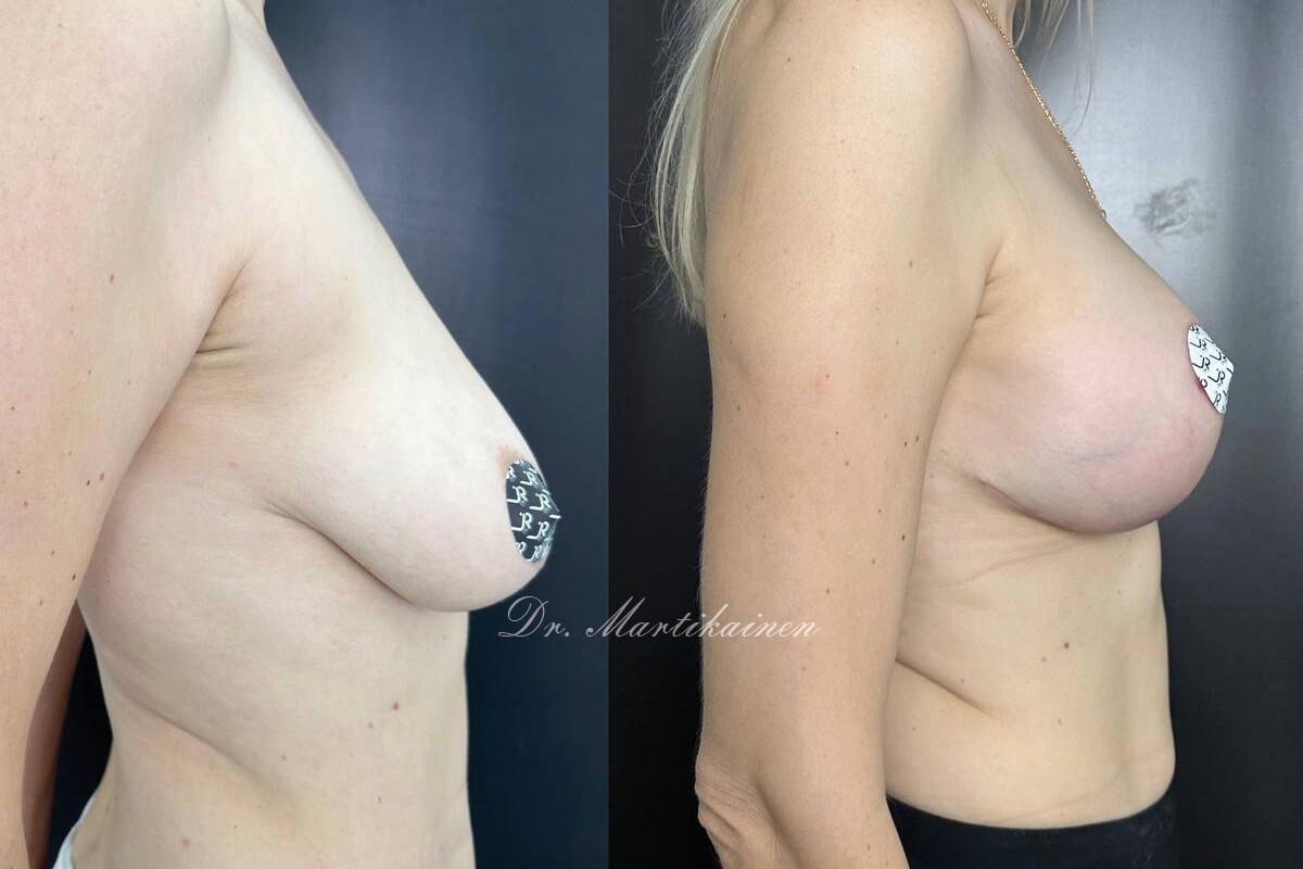 Увеличение груди имплантами 01