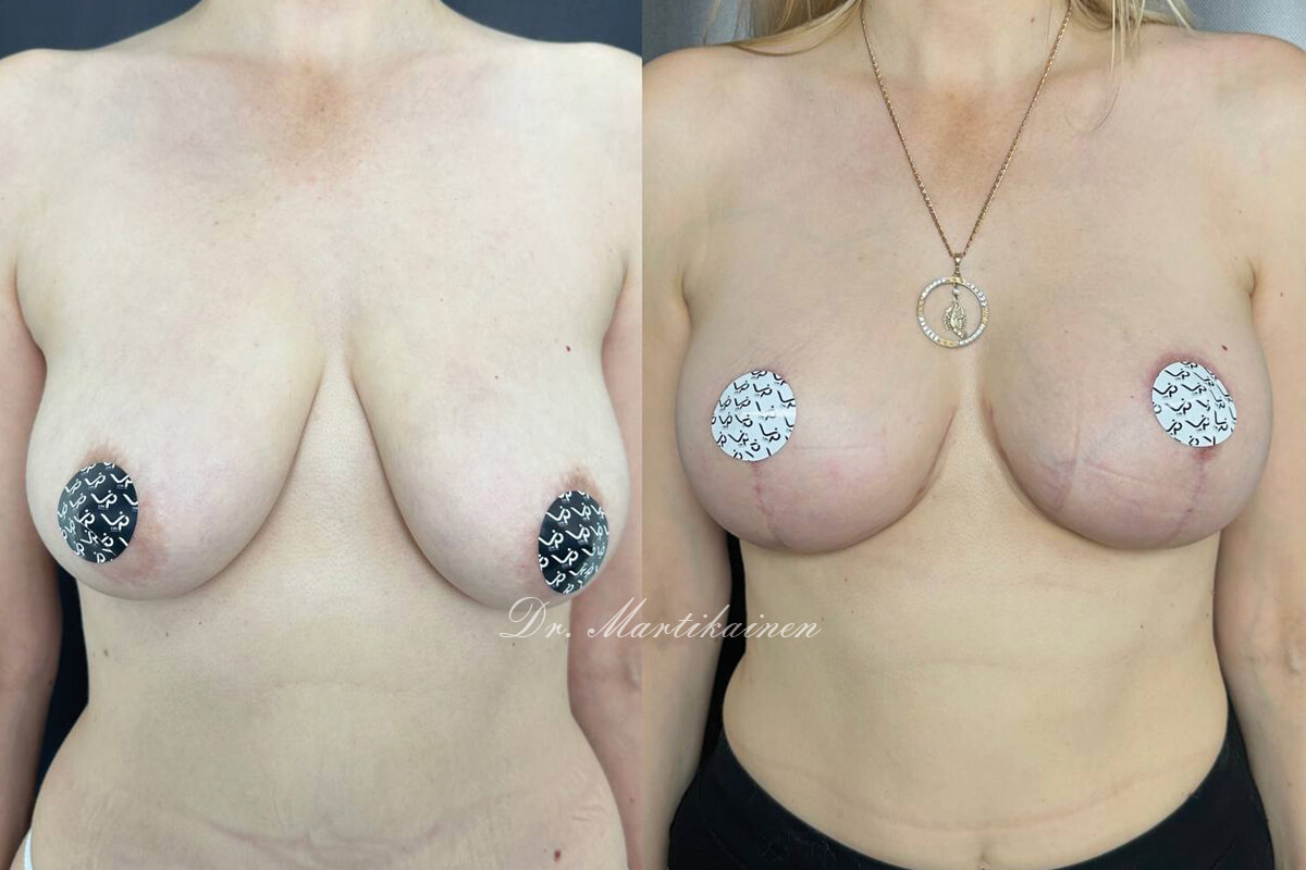 Подтяжка груди (мастопексия) 01