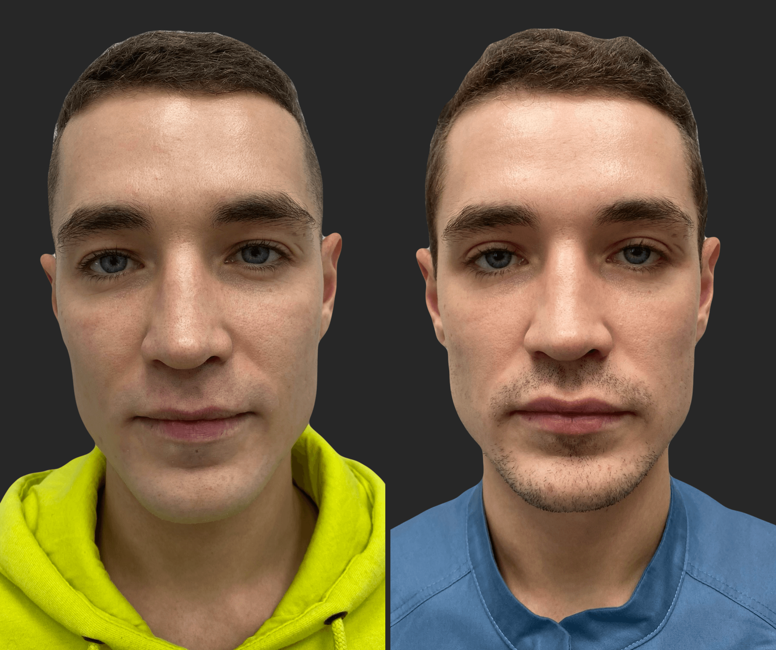 Нижняя блефаропластика 01