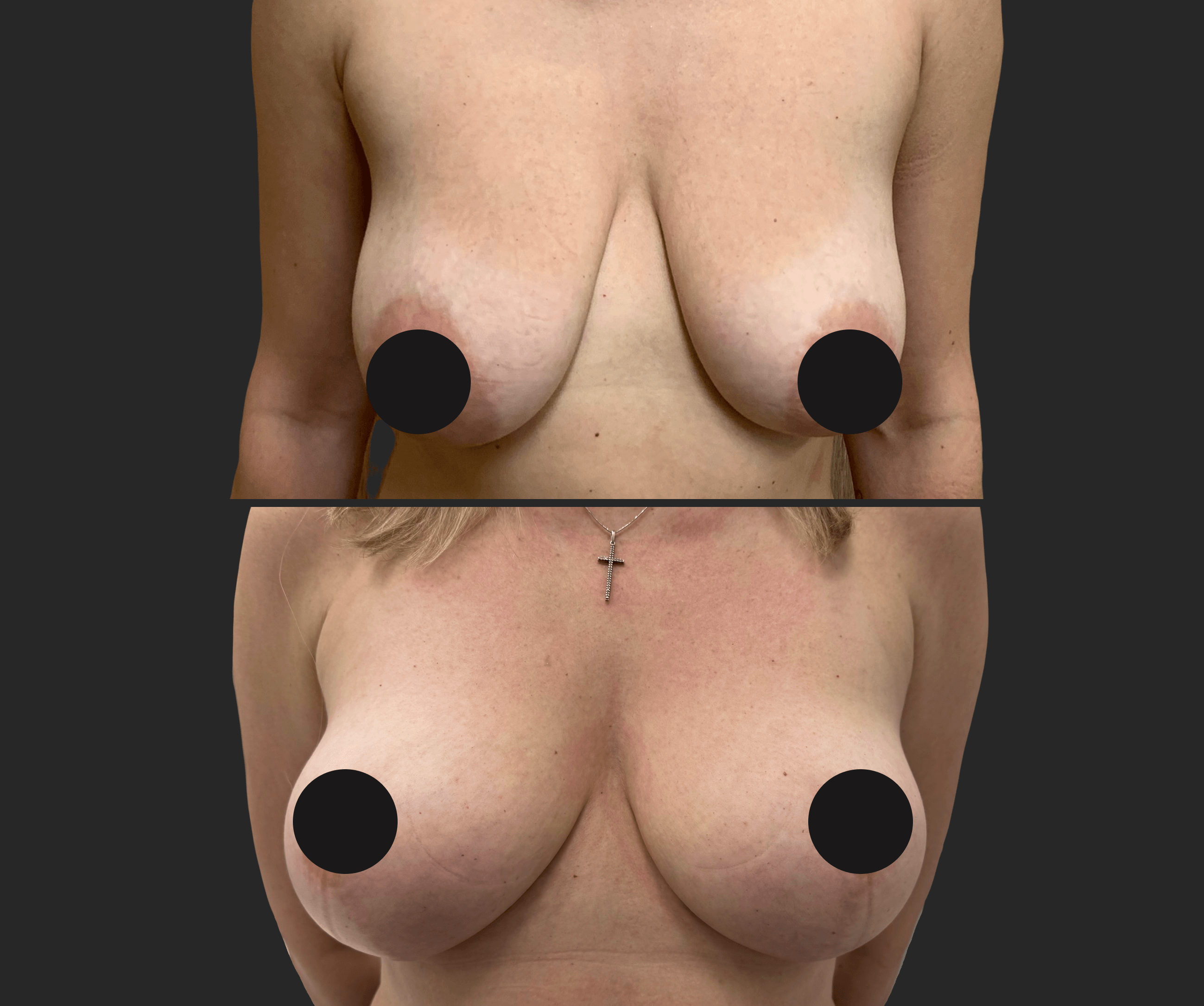 Подтяжка груди (мастопексия) 01