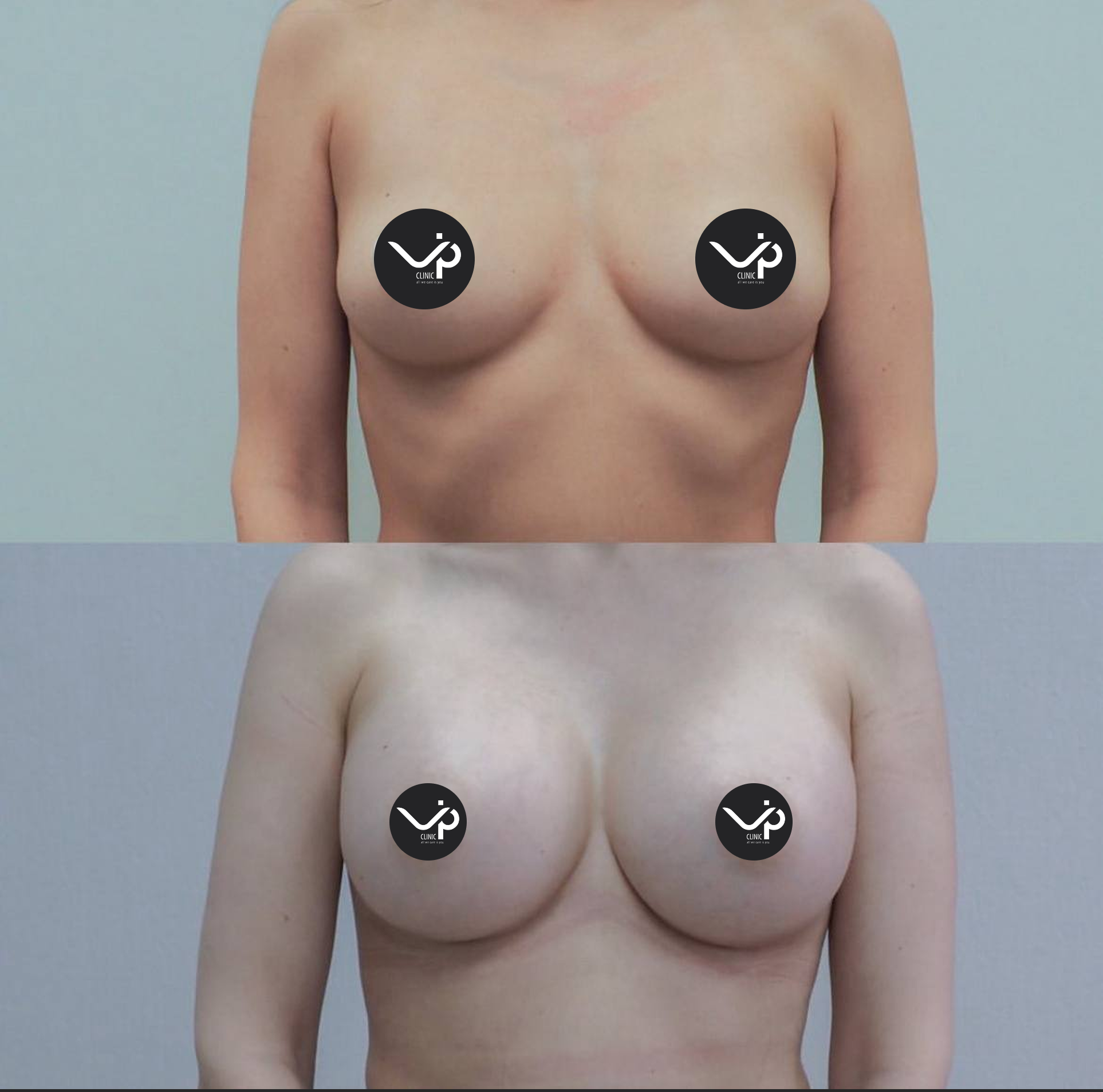 Увеличение груди имплантами 01