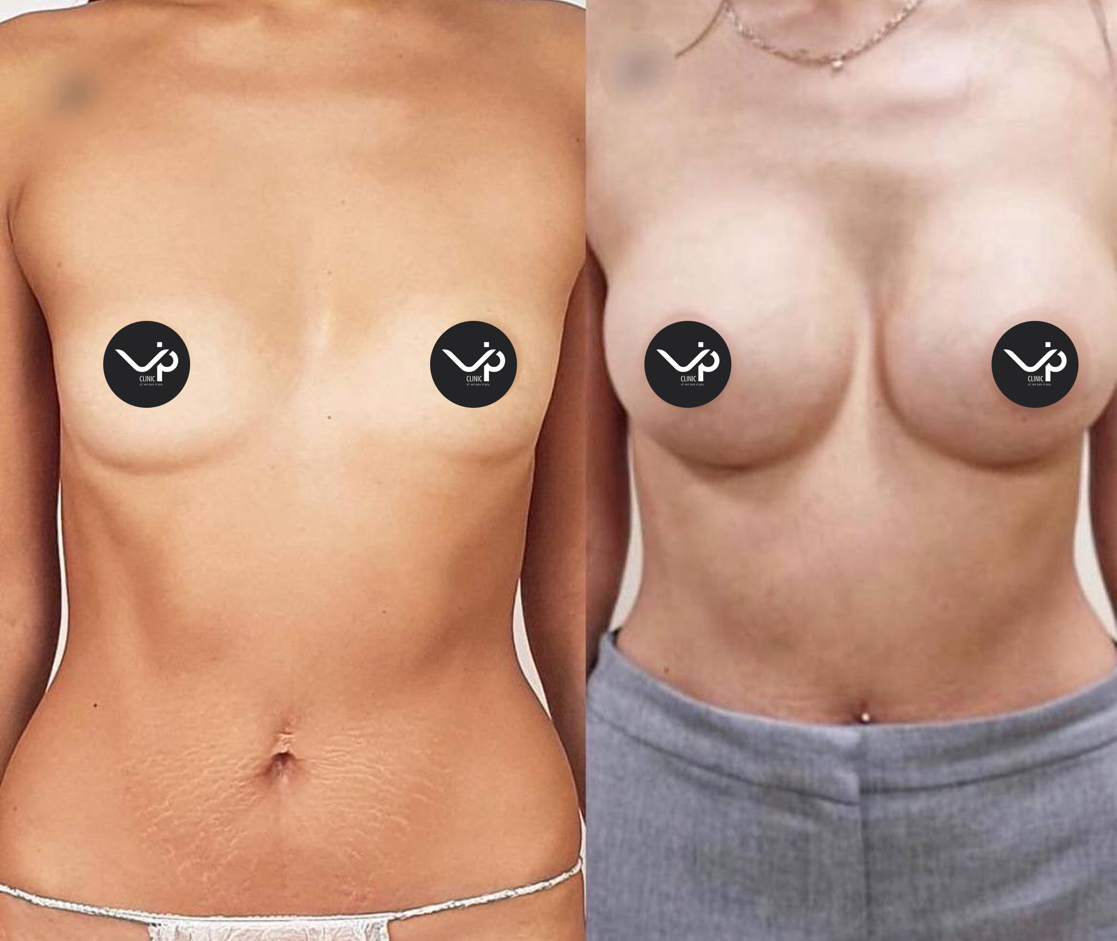 Увеличение груди имплантами 01