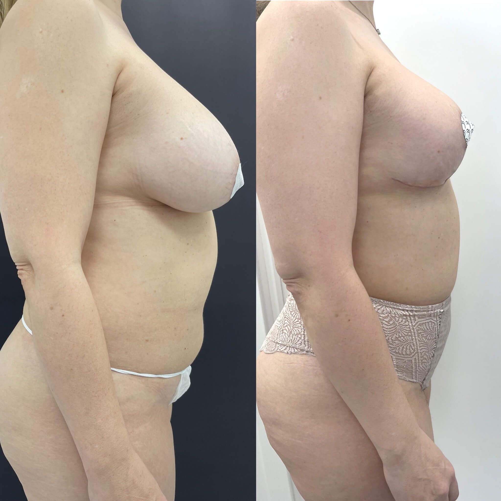 Уменьшение груди (редукция) 01