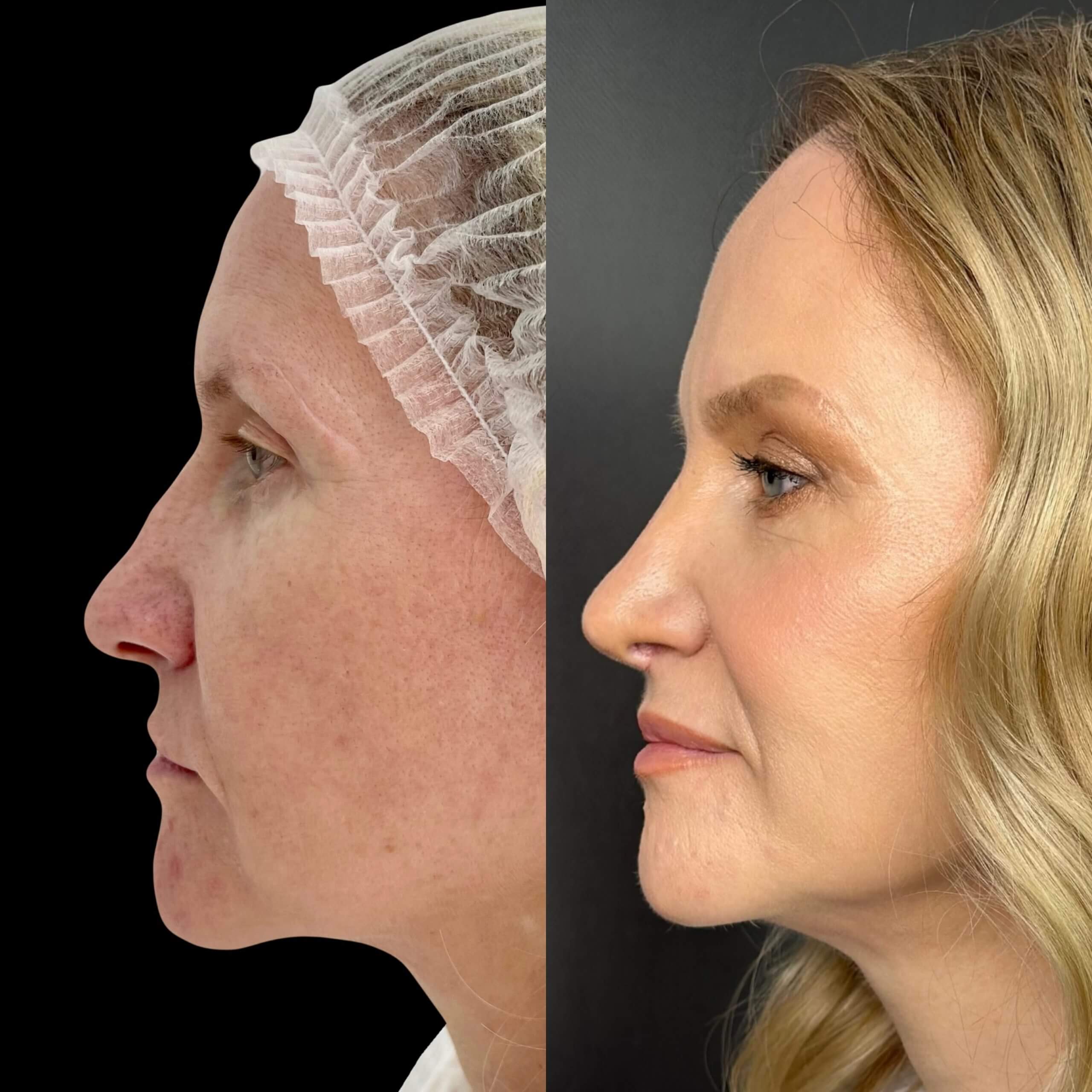 Ринопластика 01