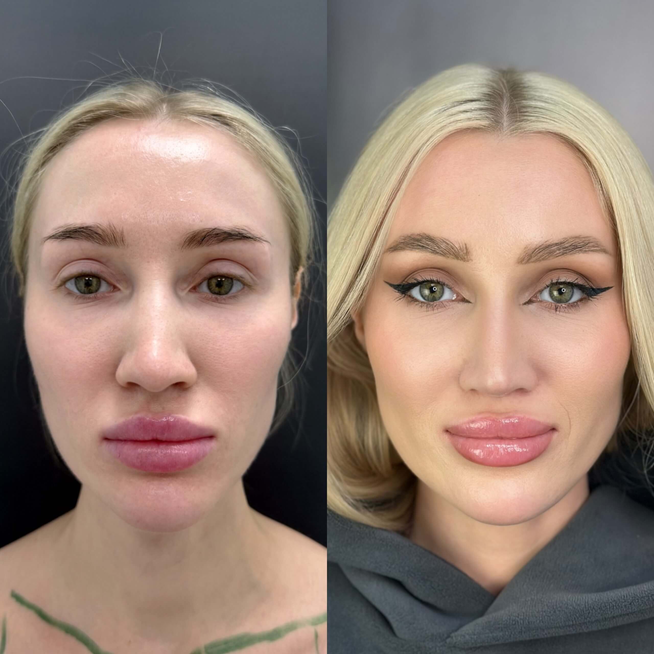 Ринопластика 01