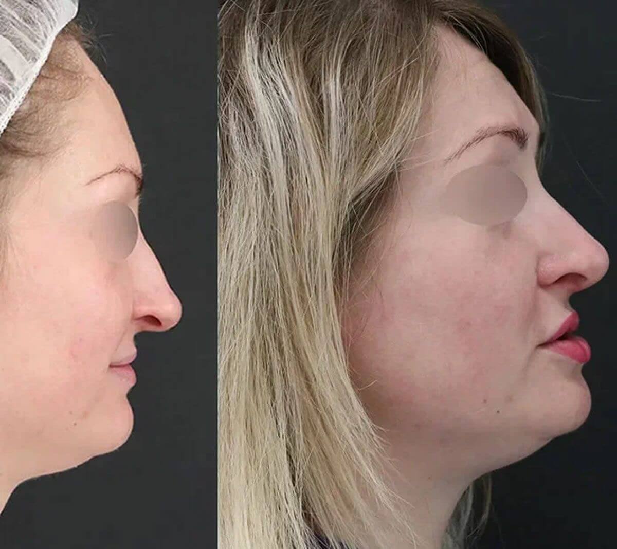 Ринопластика 01