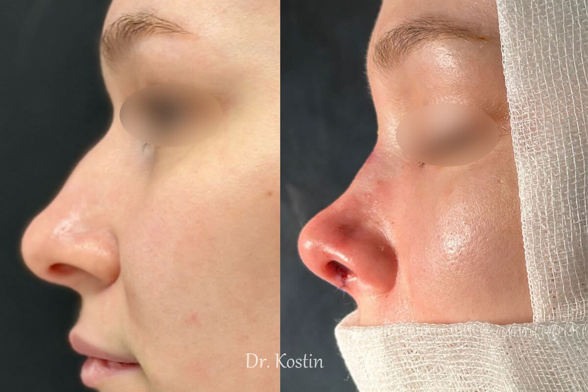 Ринопластика 01