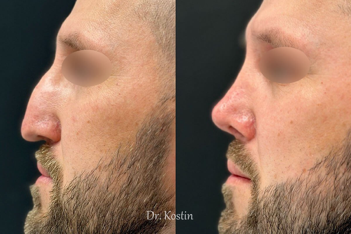 Ринопластика 01