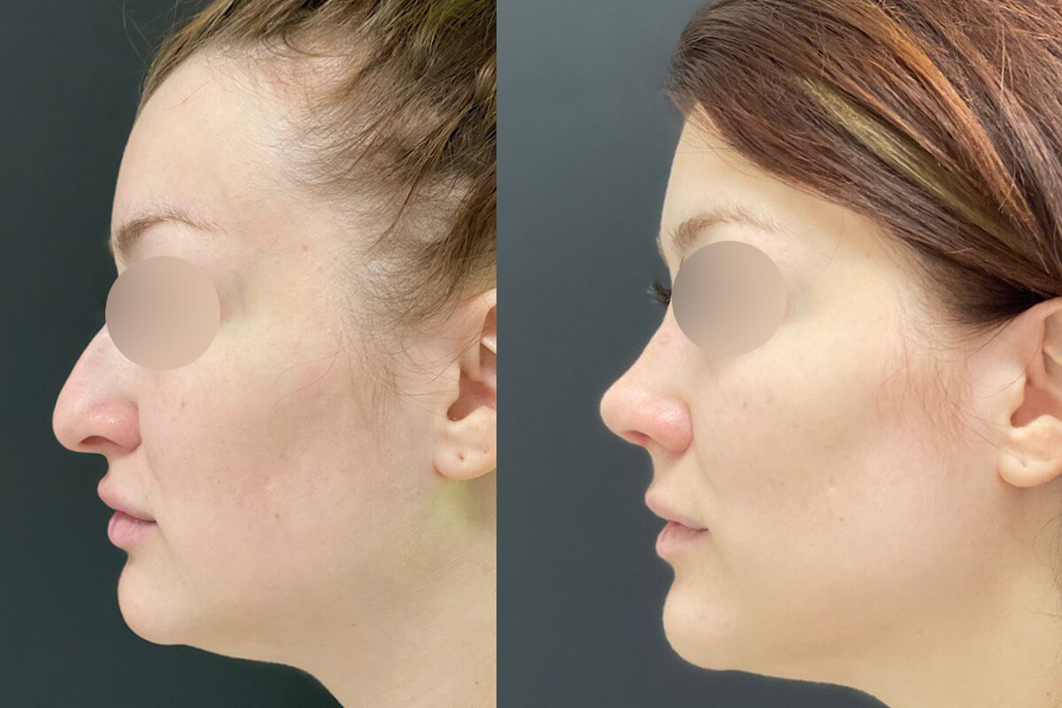 Ринопластика 01
