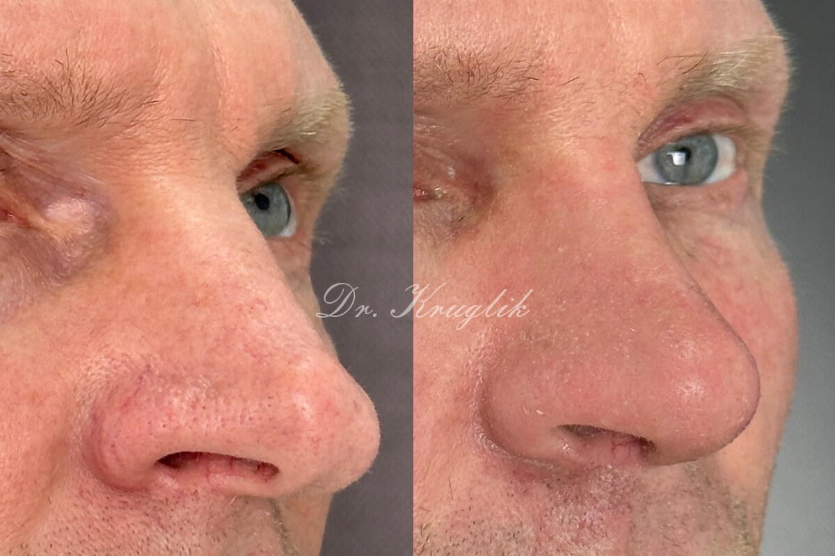 Ринопластика 01