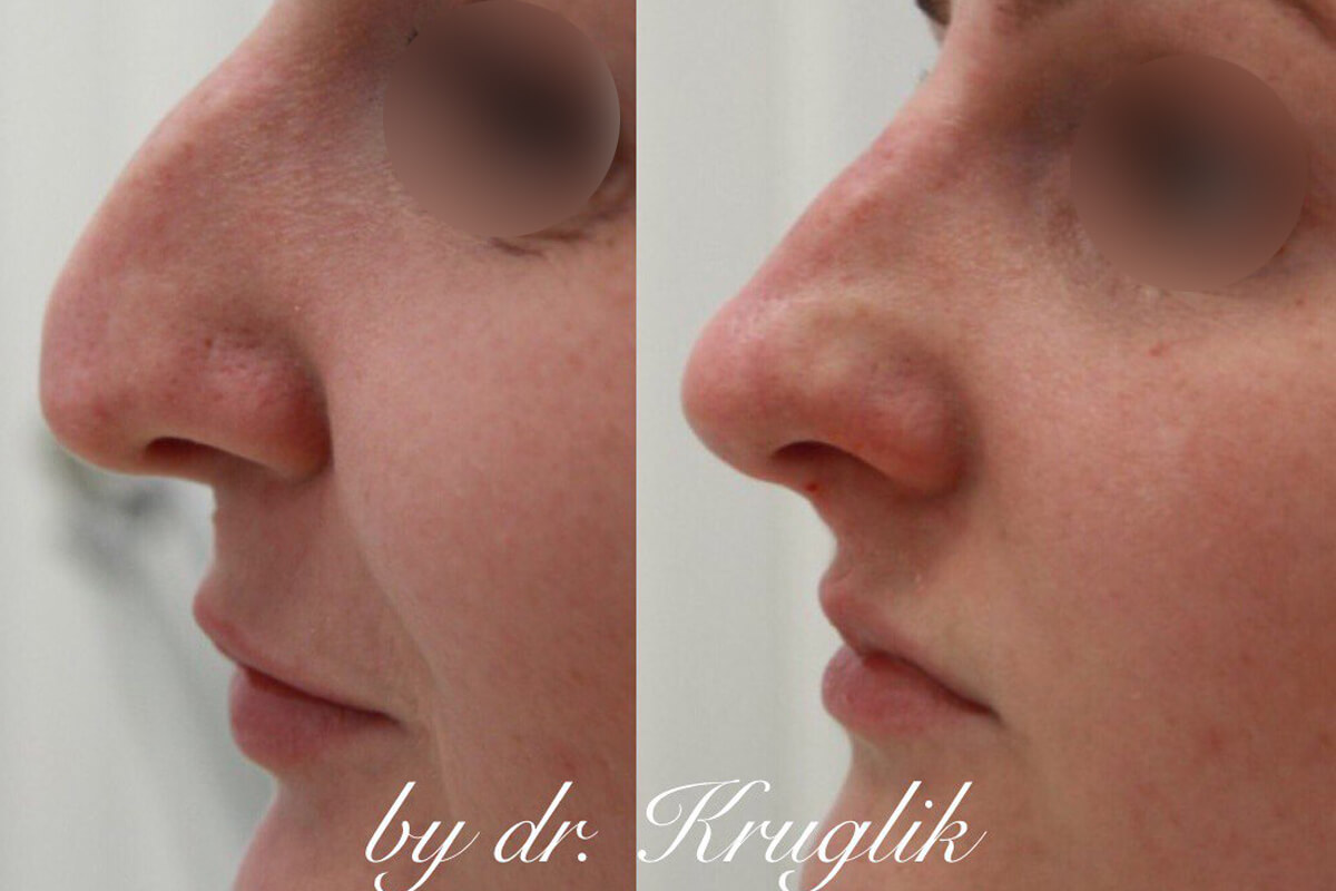 Ринопластика 01