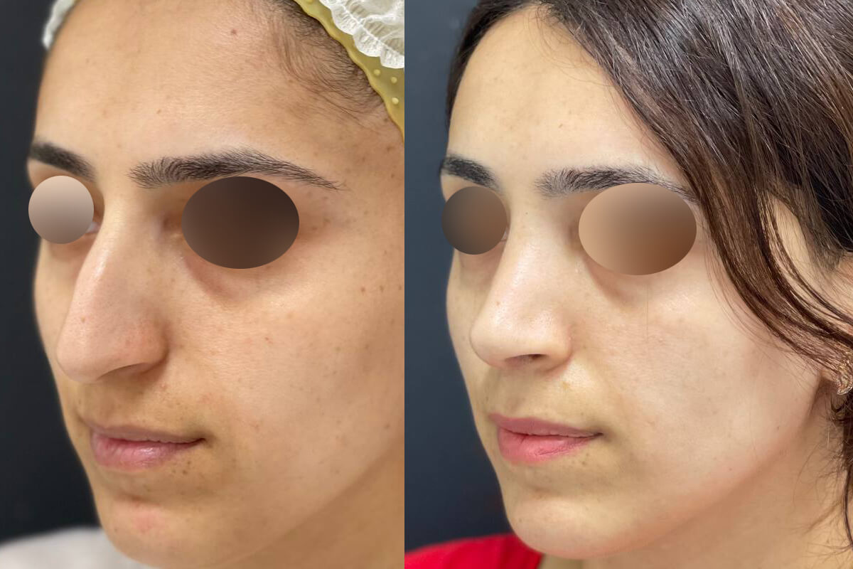 Ринопластика 01