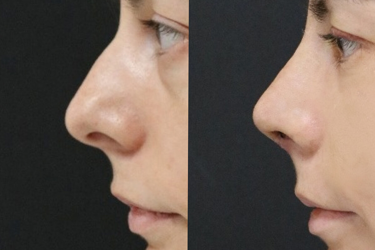 Ринопластика 01