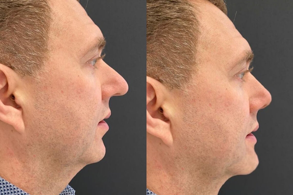 Ринопластика 01