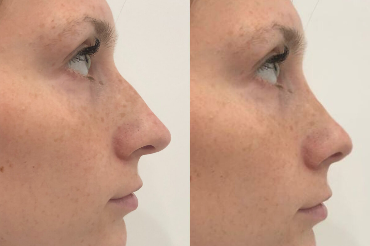 Ринопластика 01