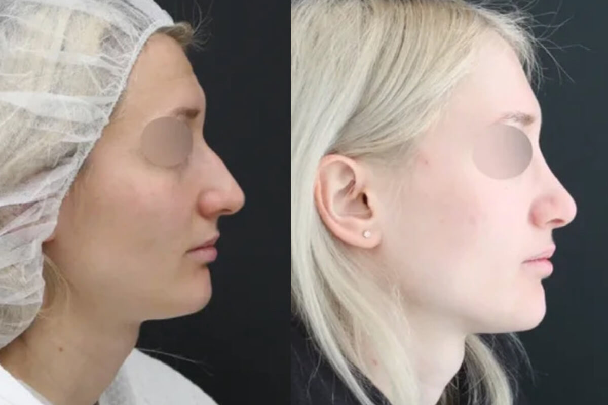 Ринопластика 01