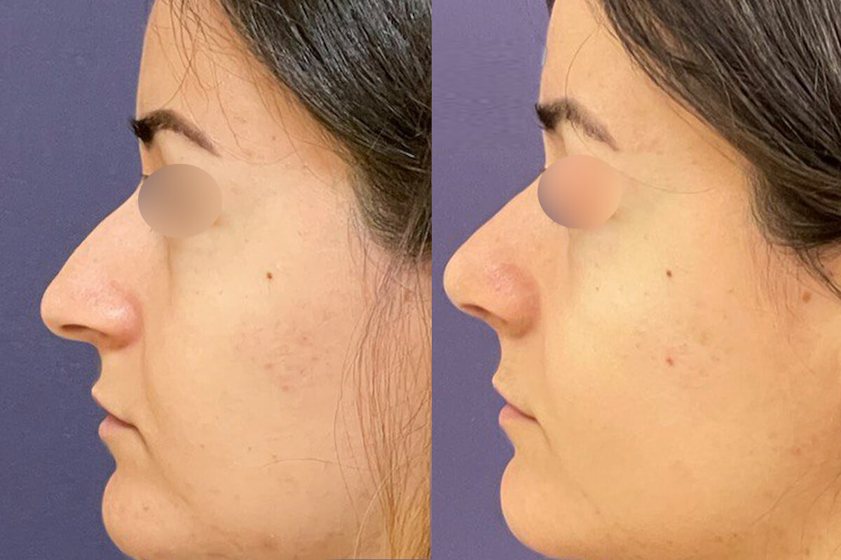 Ринопластика 01