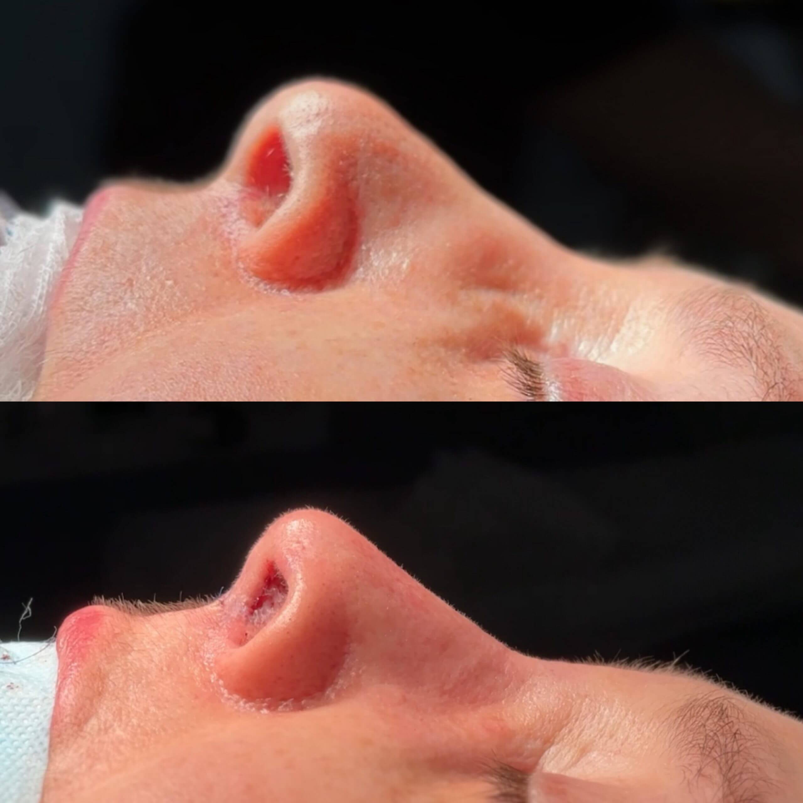 Ринопластика 01