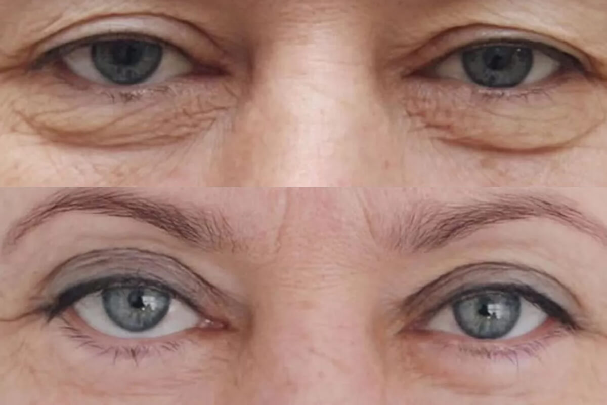 Нижняя блефаропластика 01