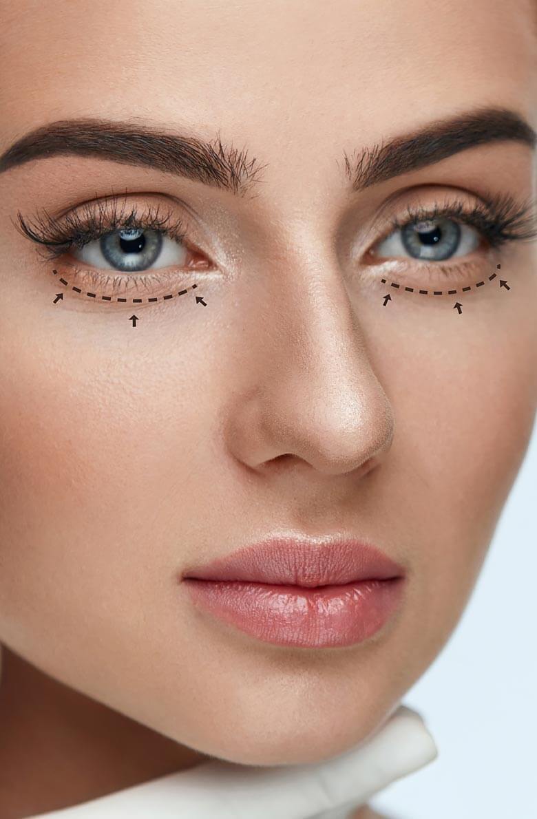 Эпикантопластика