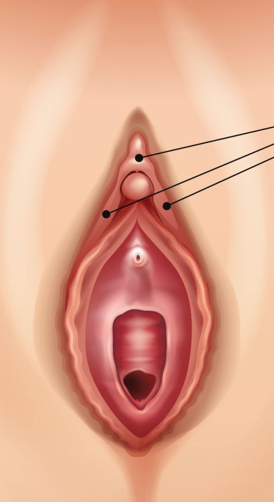 Удаление капюшона клитора