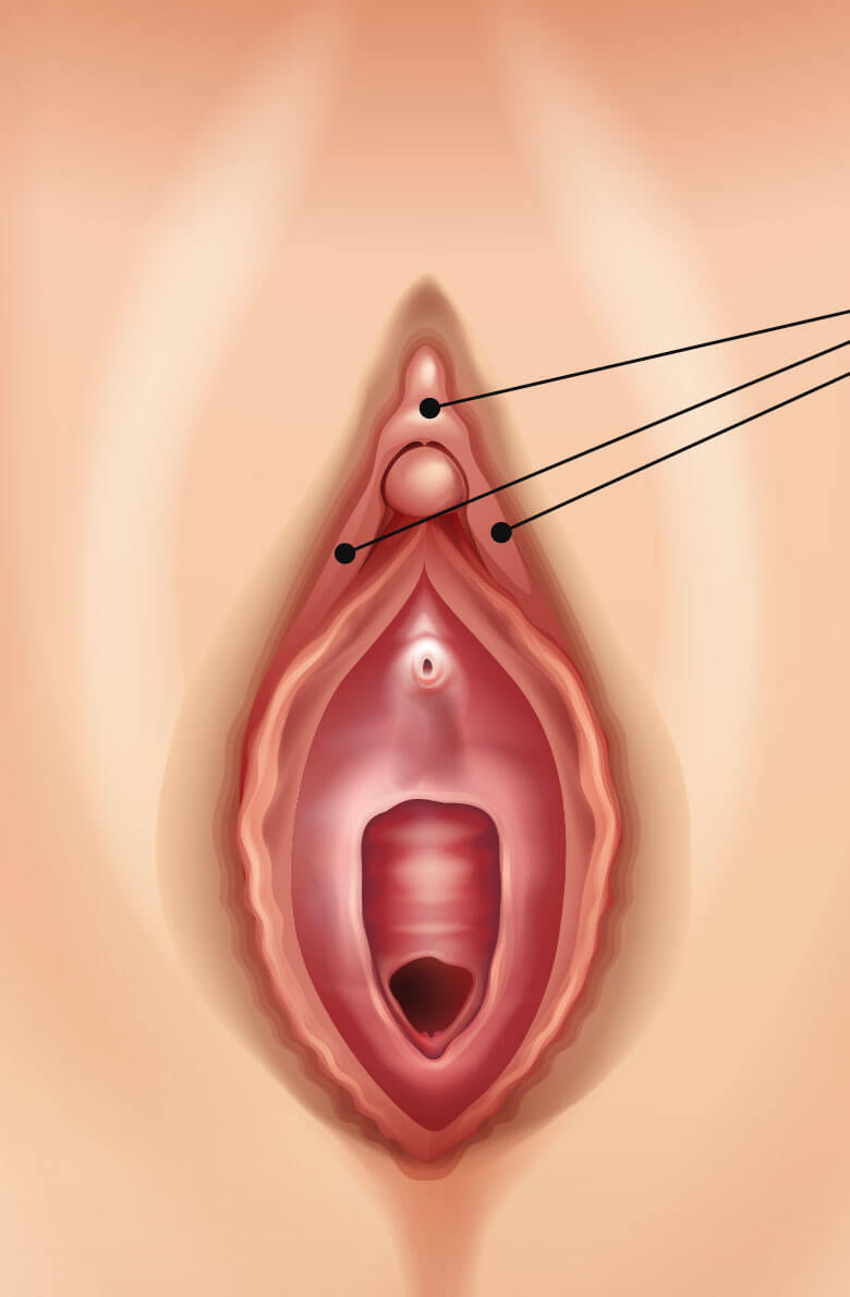 Удаление капюшона клитора