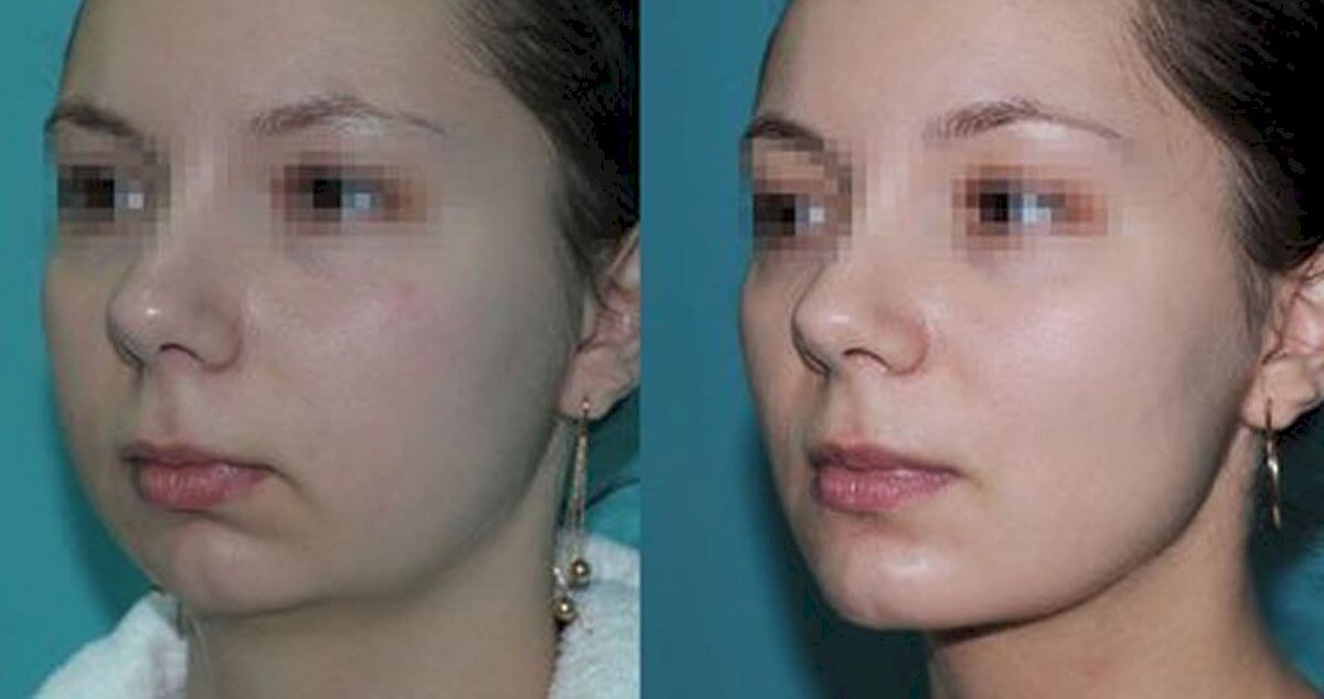 Удаление комков Биша 01