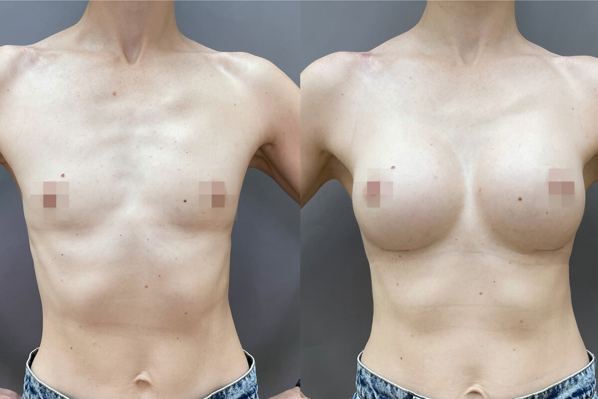 Увеличение груди имплантами 01