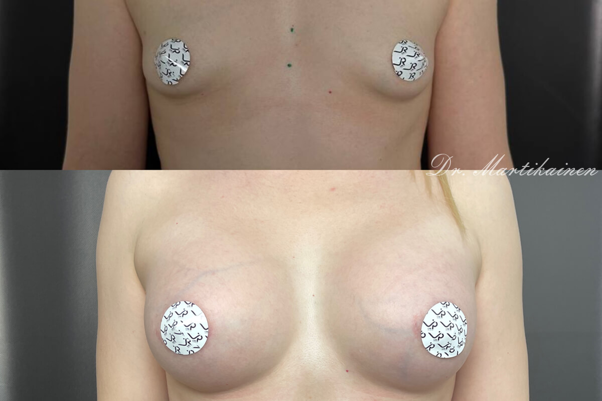 Увеличение груди имплантами 01