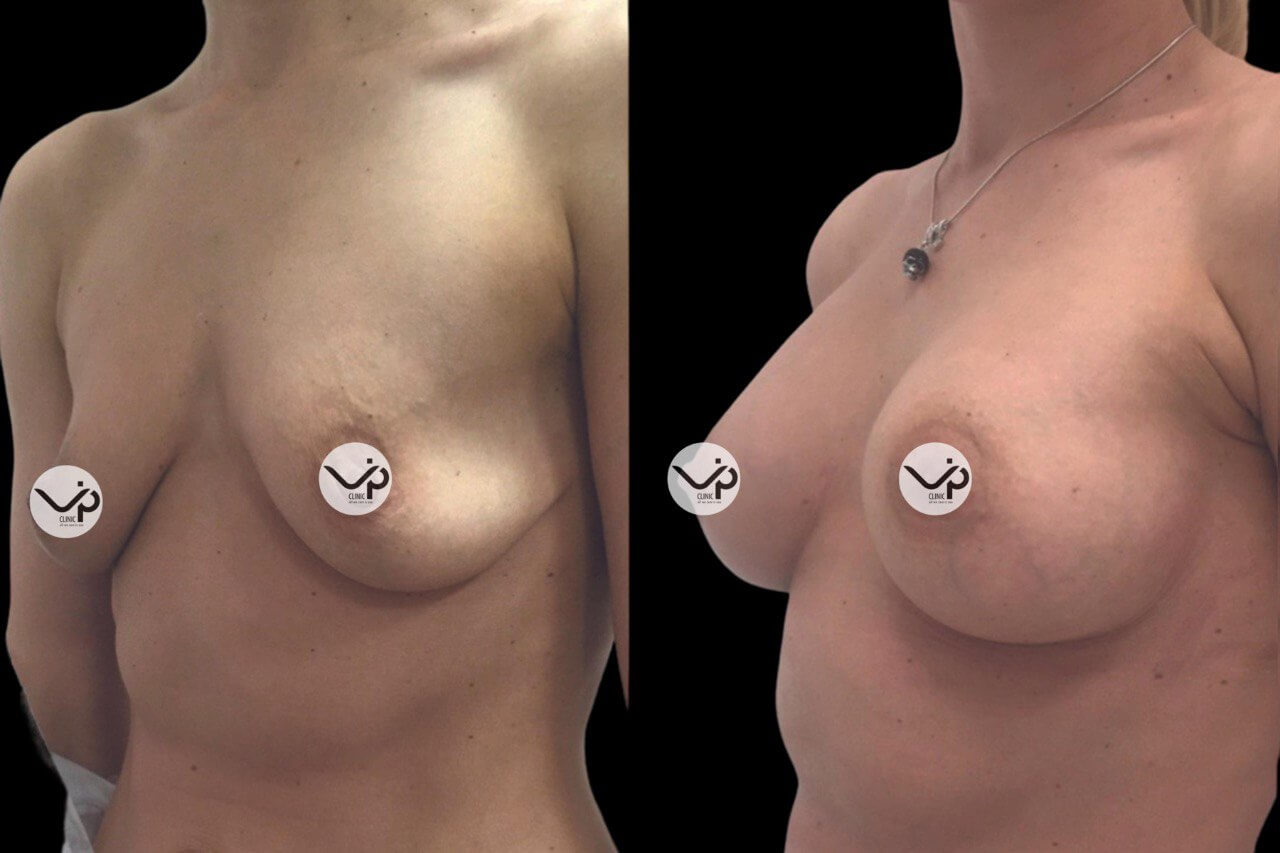 Увеличение груди имплантами 01