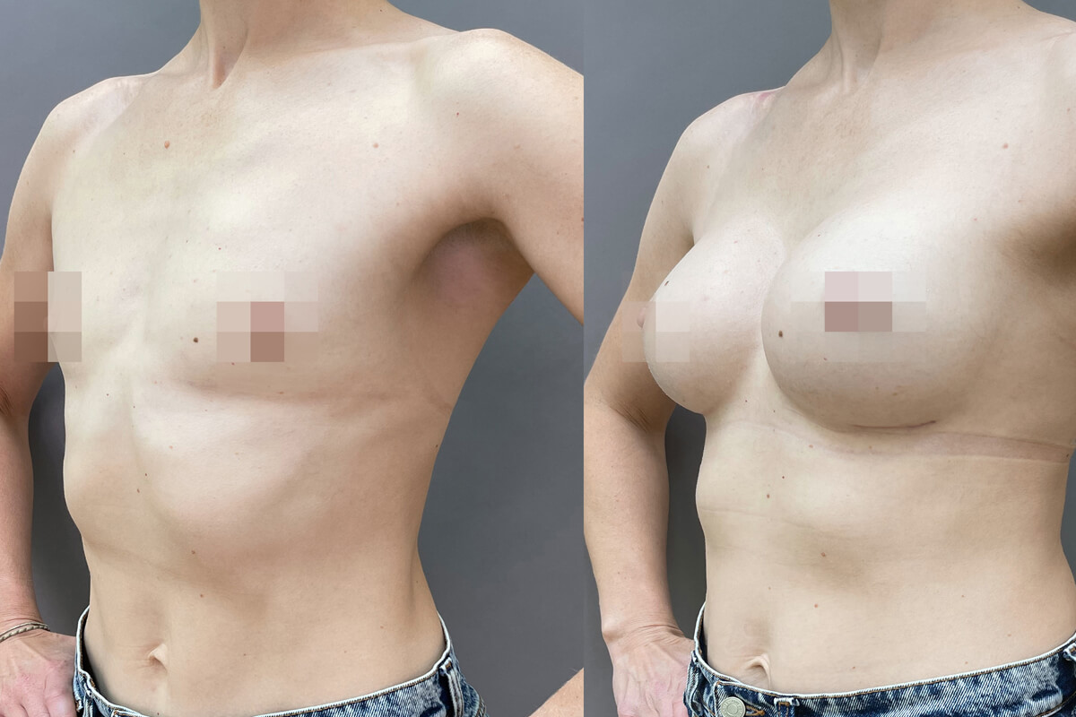 Увеличение груди имплантами 01
