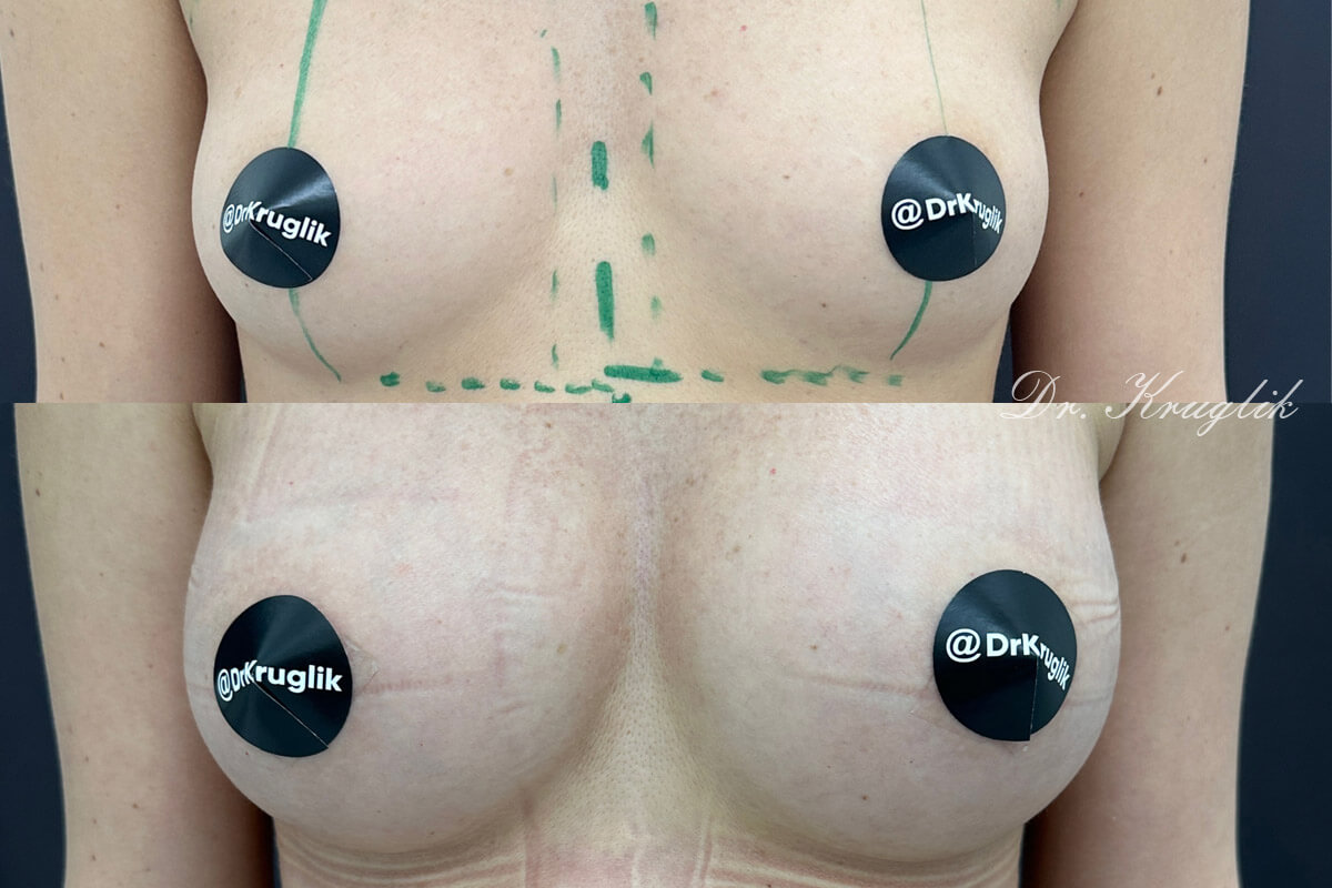 Увеличение груди имплантами 01