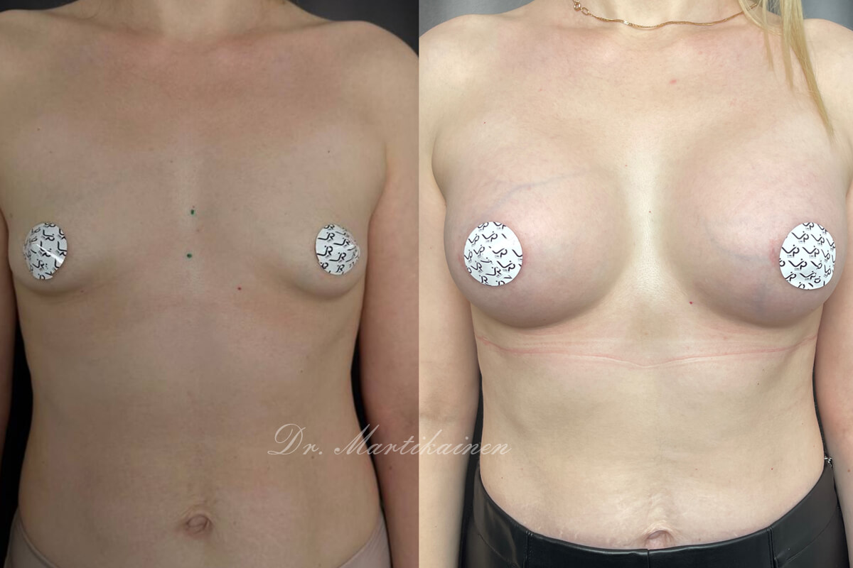 Увеличение груди имплантами 01