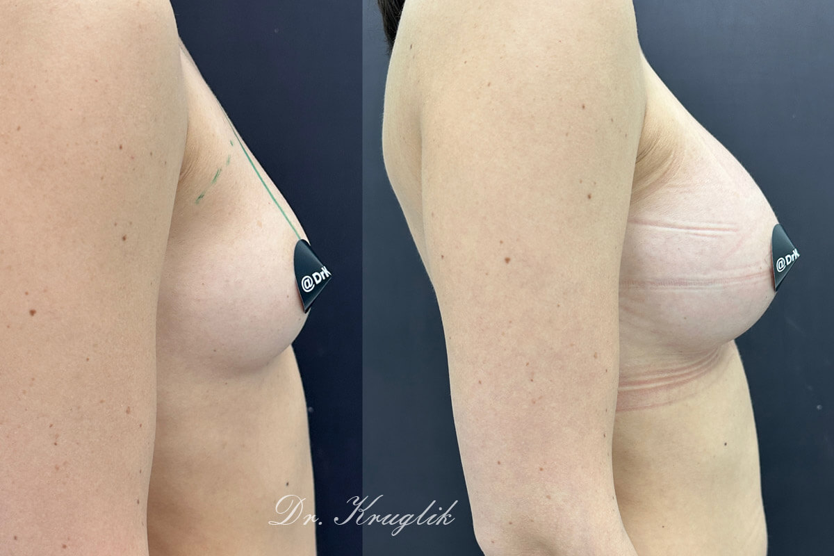 Увеличение груди имплантами 01