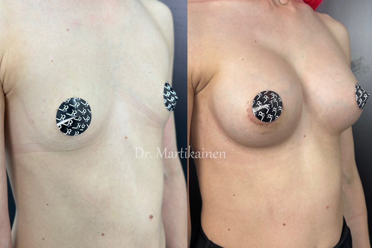 Увеличение груди имплантами 01