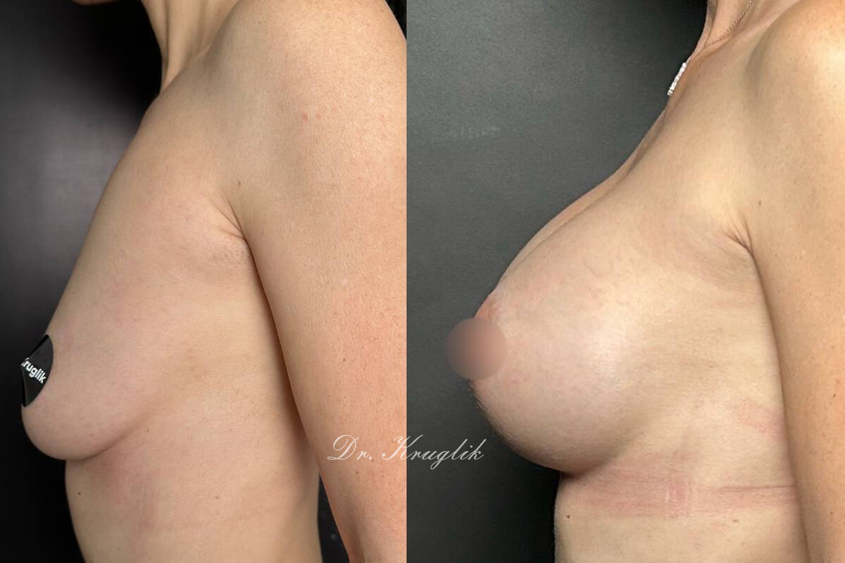 Увеличение груди имплантами 01