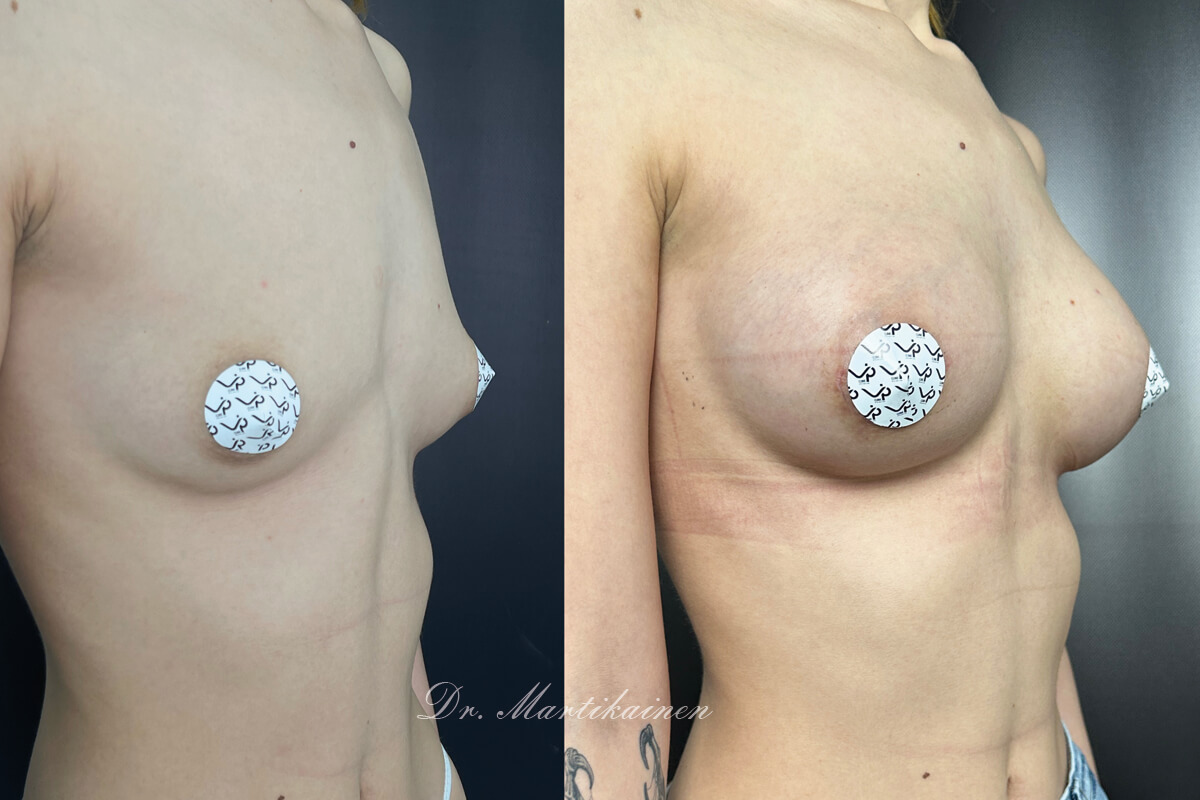 Увеличение груди имплантами 01