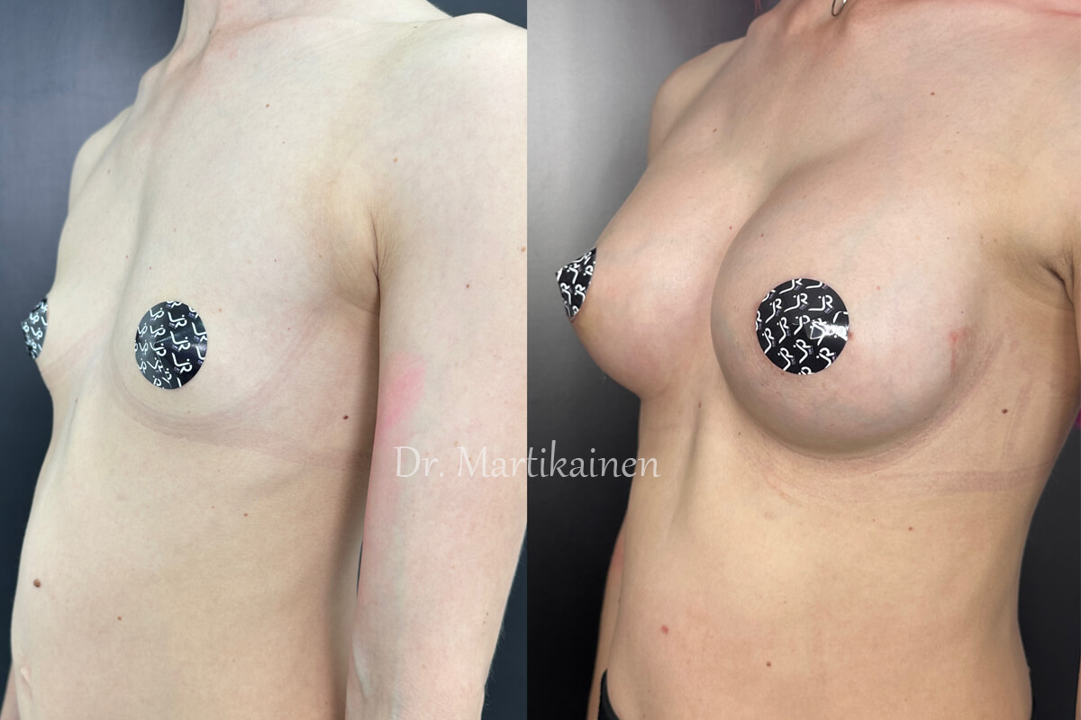 Увеличение груди имплантами 01