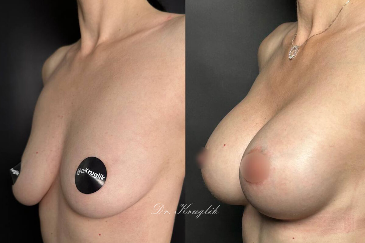 Увеличение груди имплантами 01