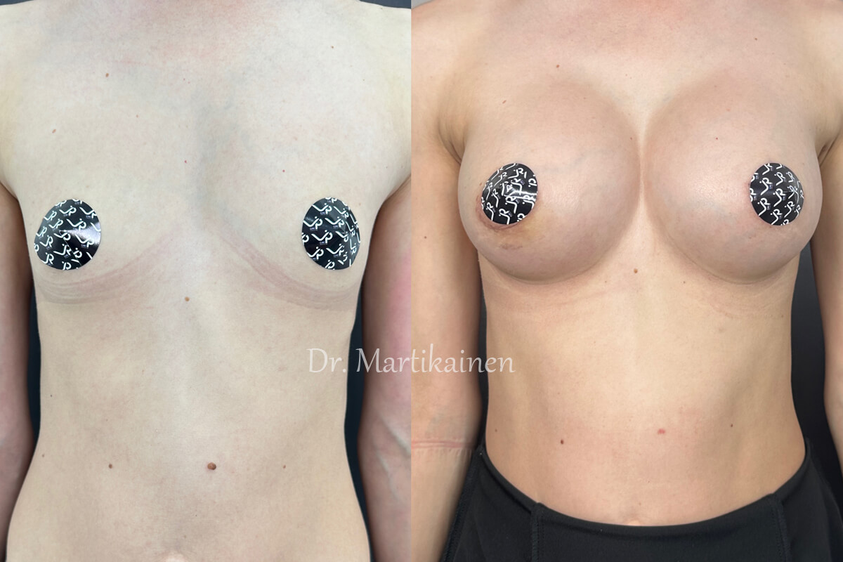Увеличение груди имплантами 01