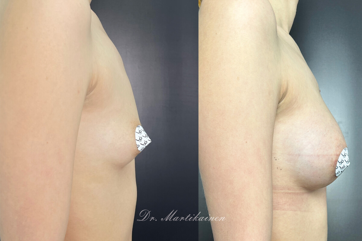 Увеличение груди имплантами 01