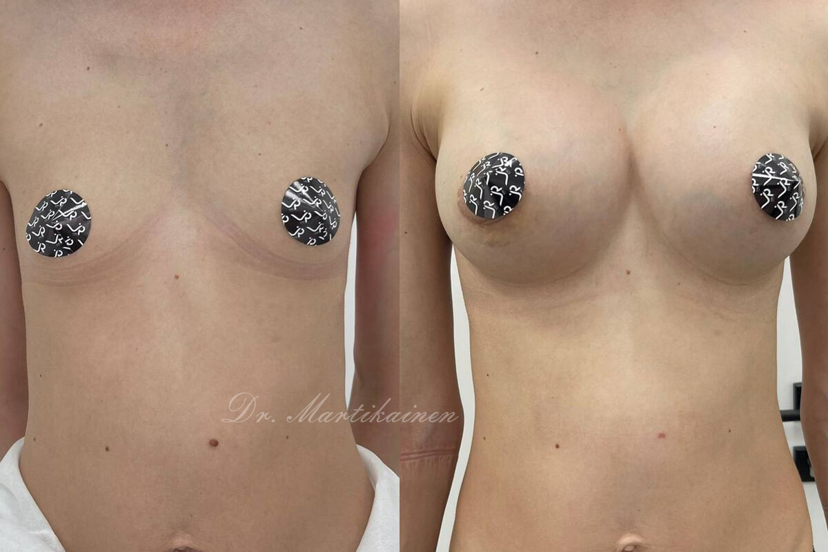 Увеличение груди имплантами 01